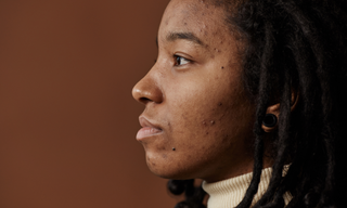 How to Treat Acne Naturally Part 2: Hormonal Imbalance