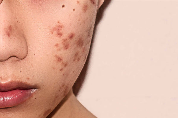 Can I Really Heal My Acne Scars Naturally?