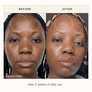 Before and after image showing customer results of clear, glowing skin with the Neroli Mist over the course of two weeks
