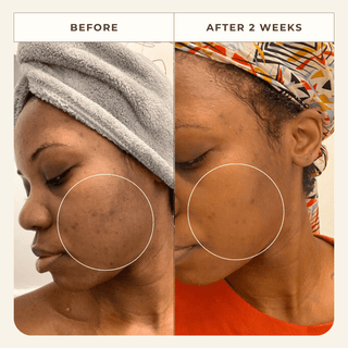 Apoterra client skincare results after 2 weeks of using products showing reduced dark spots and clearer complexion 