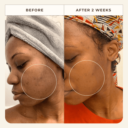 Apoterra client skincare results after 2 weeks of using products showing reduced dark spots and clearer complexion 