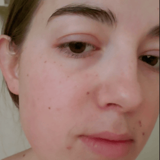 Close up of a customer's face showing improvement after use of Apoterra's vitamin c regenerative balm