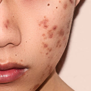 A closeup of a face showing acne & scarring