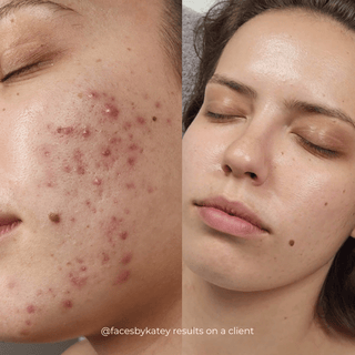 Before and after comparison of a woman's face with acne on the left and clear skin on the right after use of Apoterra's Skin Barrier Repair products