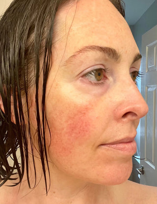 Woman's glowing review after using Apoterra's Sea Berry Facial oil for her reactive, rosacea prone skin