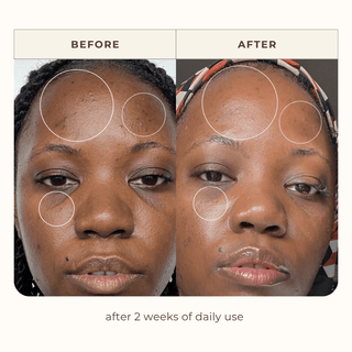 Model before & after showing skin improvement after 2 weeks of use with Apoterra's clean skincare best selling products