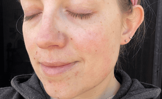 Close up of a woman's face showing reduced acne, redness and inflammation after use of Apoterra clean skincare products