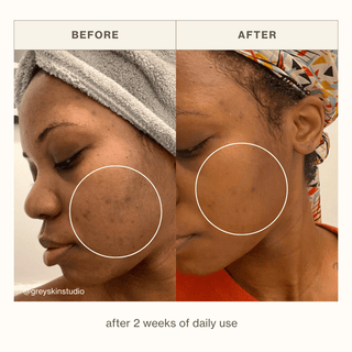 Apoterra client skincare results after 2 weeks of using products showing reduced dark spots and clearer complexion 