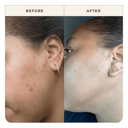 Before & After results of client using Apoterra's Vetiver Oil Cleanser for targeting acne support